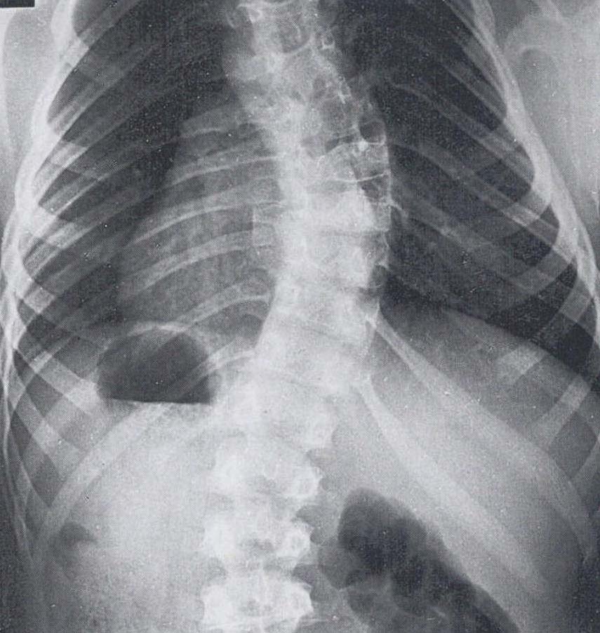 年輕脊柱側凸病人
